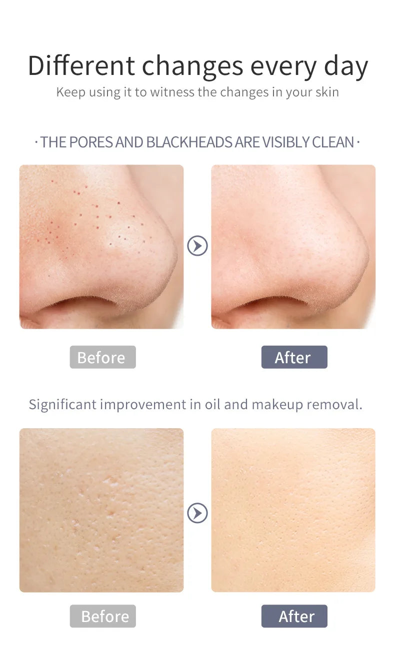 Ultrasonic Pore Cleanser