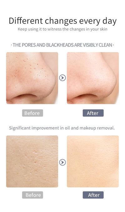 Ultrasonic Pore Cleanser