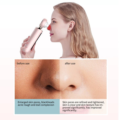 facial blackhead remover